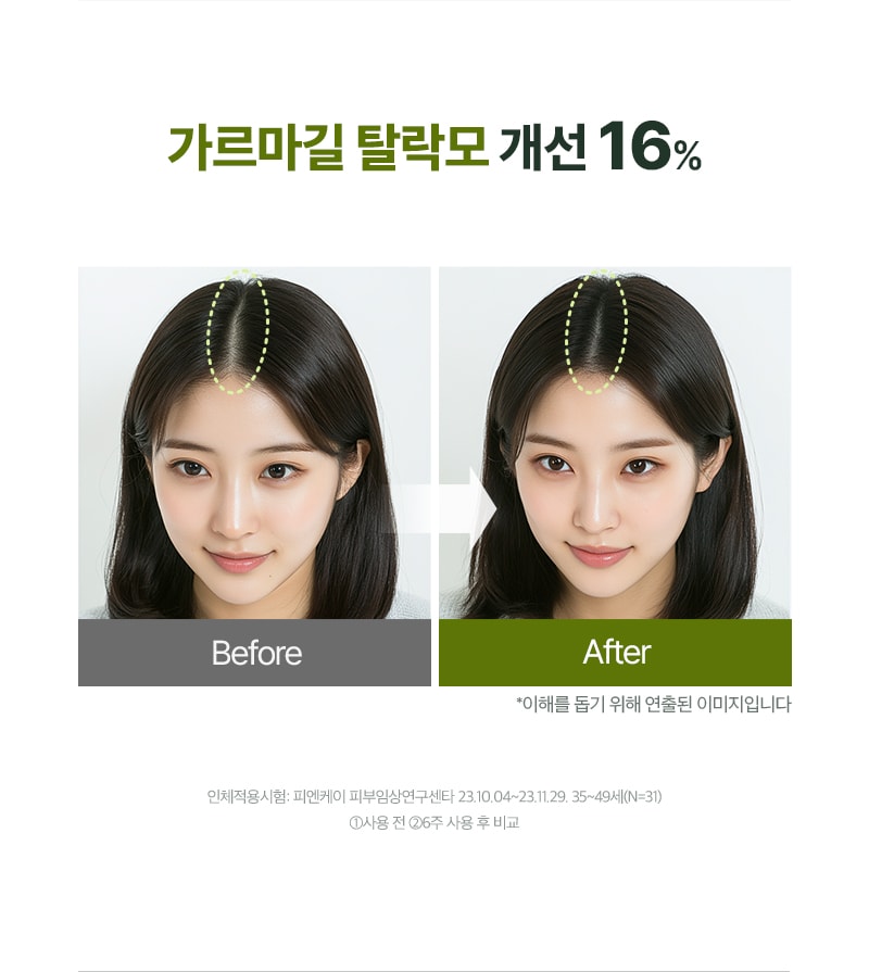 가르마길 탈락모 개선 16%